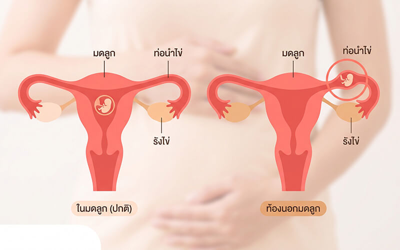 เปรียบเทียบตัวอ่อนฝังในมดลูกปกติ กับท้องนอกมดลูกในท่อนำไข่